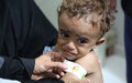 Las crecientes tasas de hambre y malnutrición en Yemen preocupan al PMA 